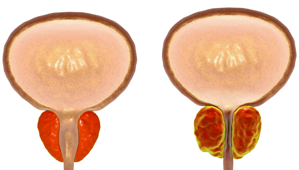 Čo je prostatitída