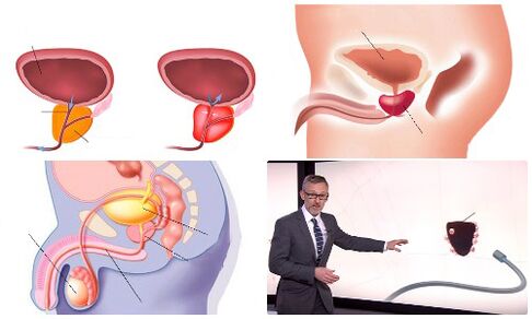 zdravá a chorá prostata